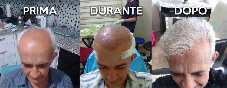 Infoltimento del vertice · prima, durante e dopo